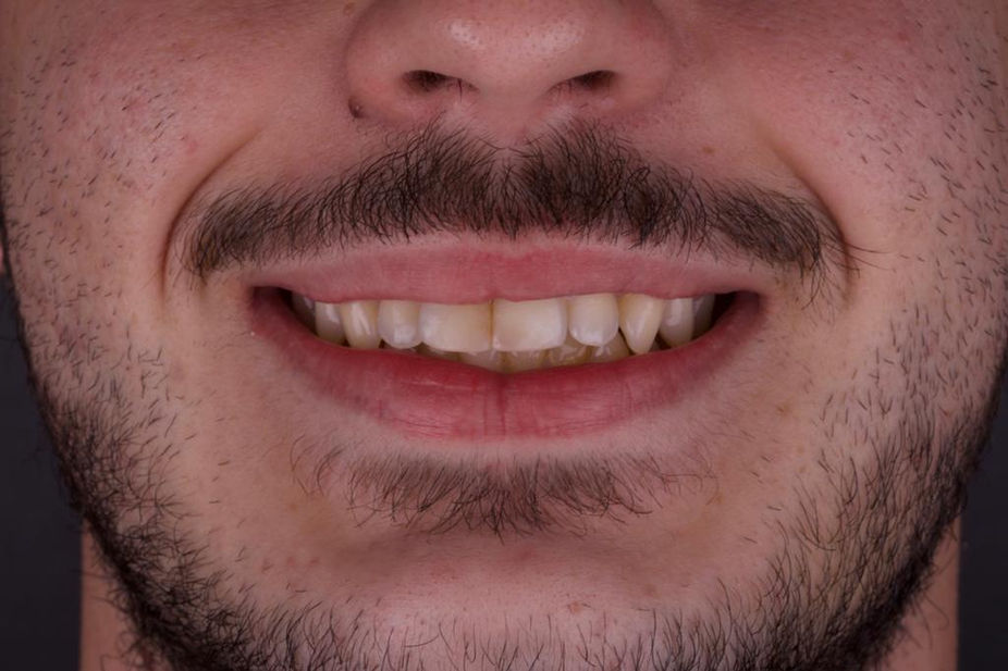 Antes e Depois Lentes de Contato Dental em Resina