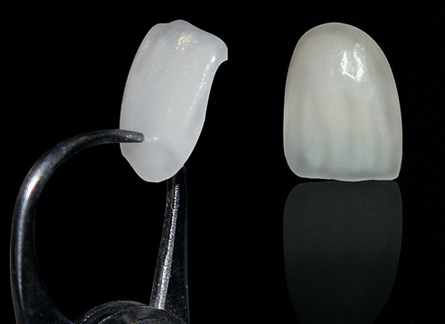 Lente de Contato Dental - Observe a fina espessura.