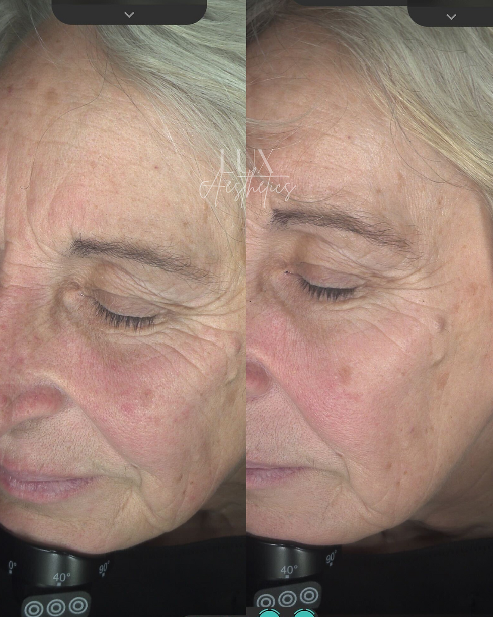 Before + after 3 sessions of Skin Needling