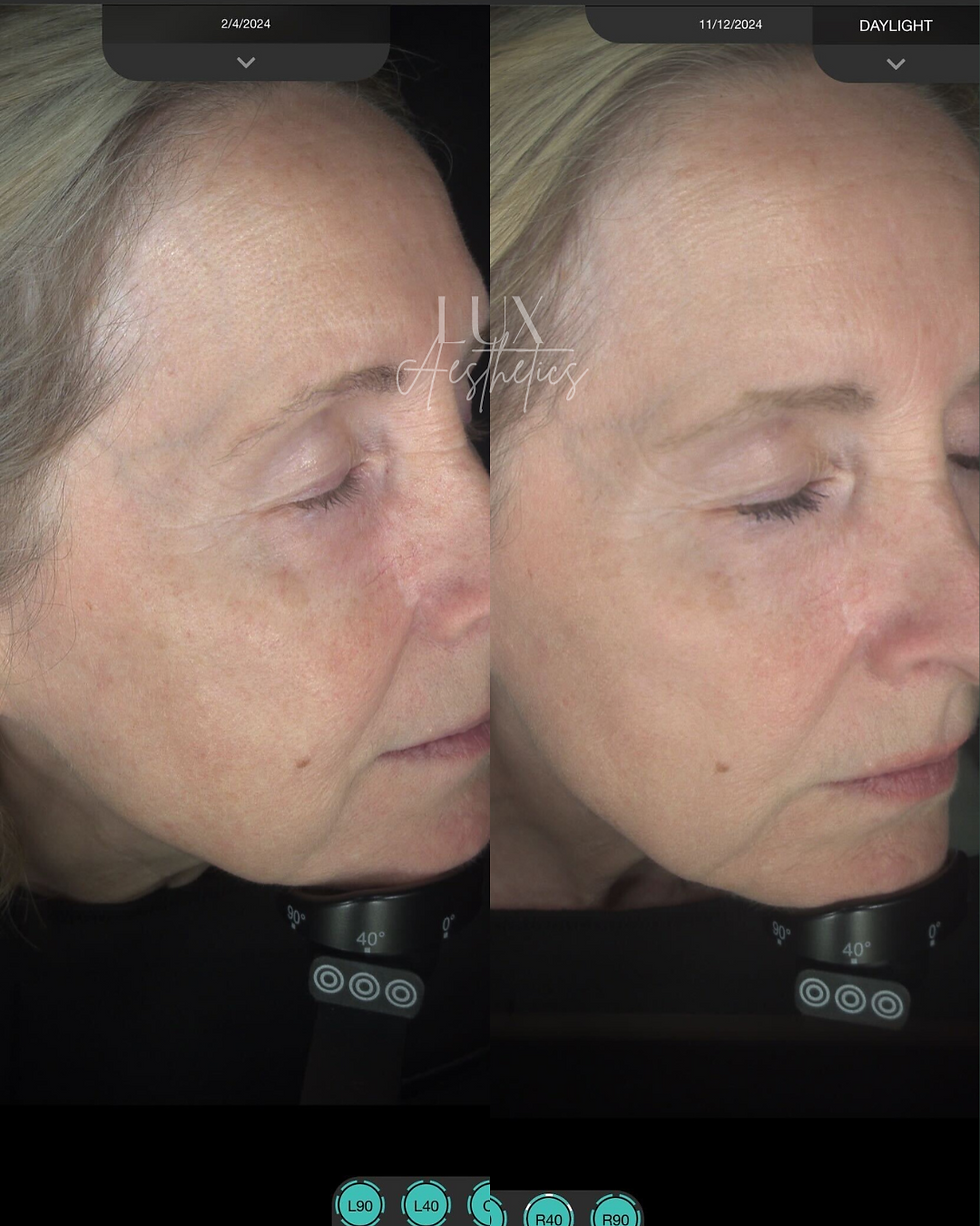Before and after 4 skin needling sessions