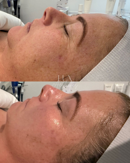 Skin treatment before and after