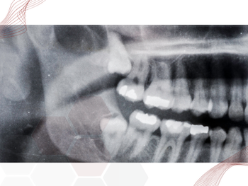 Porque é indicado remover os dentes inclusos?