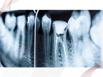 O que é Radiografia Periapical?