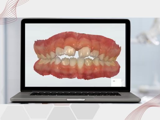 O que significa o termo STL na Odontologia