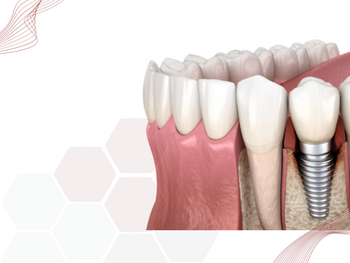 Análise tridimensional da perda óssea: Precisão no diagnóstico e tratamento