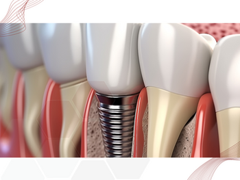 Implantodontista: Dúvidas sobre a osseointegração ou a posição exata dos implantes no pós-operatório