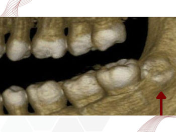 Dentes Supranumerários na tomografia por feixe cônico