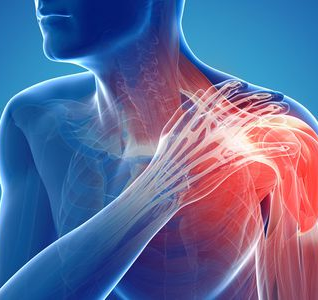 Pectoralis major ruptur