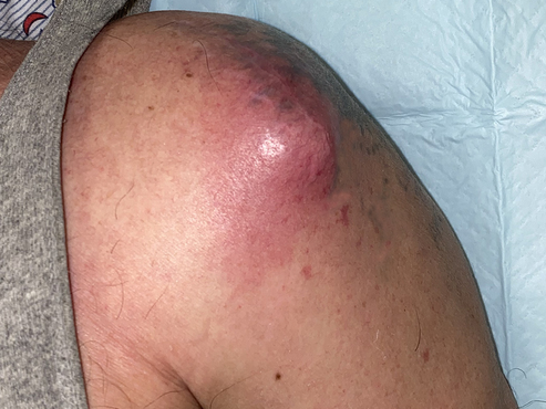 Deltoid Abscess