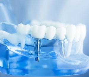Dental tooth dentistry student learning teaching model showing teeth, roots, gums, gum disease, toot