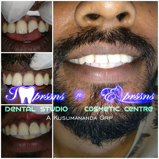 Fractured front teeth with PFM crown