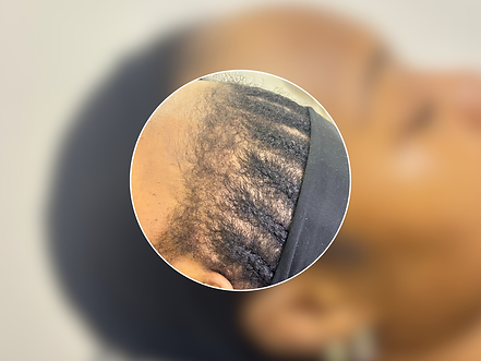 Fainahlee PRP Treatment for Thinning Hair Edges and hairline .png