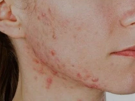 Akne (Sivilce) ve Akne İzleri Nasıl Geçer?