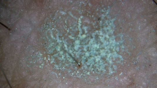 FRECKLE COATED WITH FORMULA MINERALS