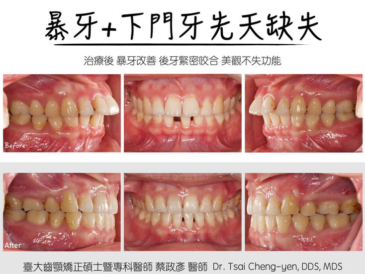 Class II_v_Protrusion_2-bi ext 3