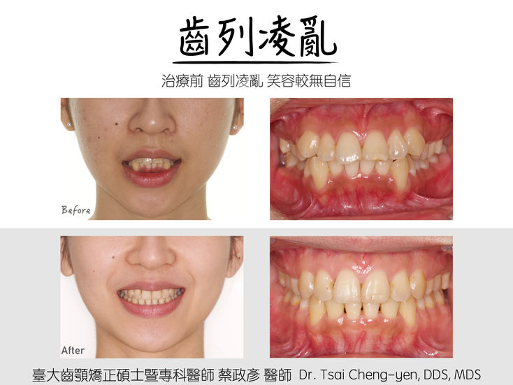 Class I_v_crowding_4-bi ext. 2.jpeg