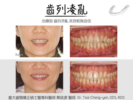 齒列凌亂