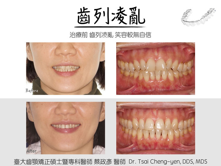 Class I_v_crowding_non-ext with Invisalign_1 2.jpeg
