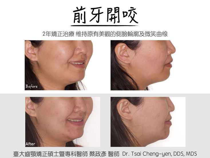 Class III_v_AOB_TMD_non-ext 5