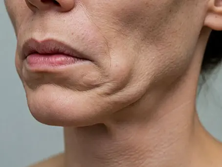 Ozempic and GLP-1 Face: What to Do About Facial Volume Loss on GLP-1 Medication
