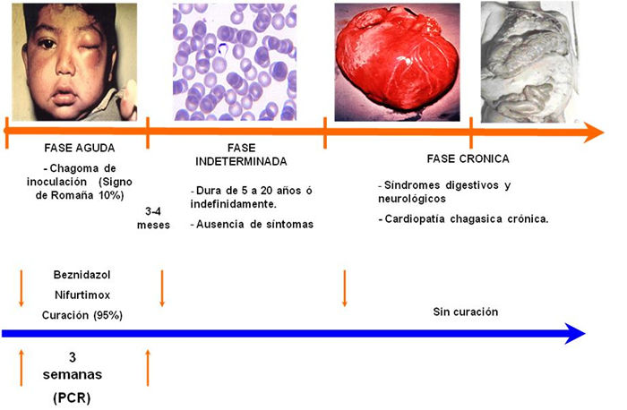 Fases de la enfermedad de Chagas