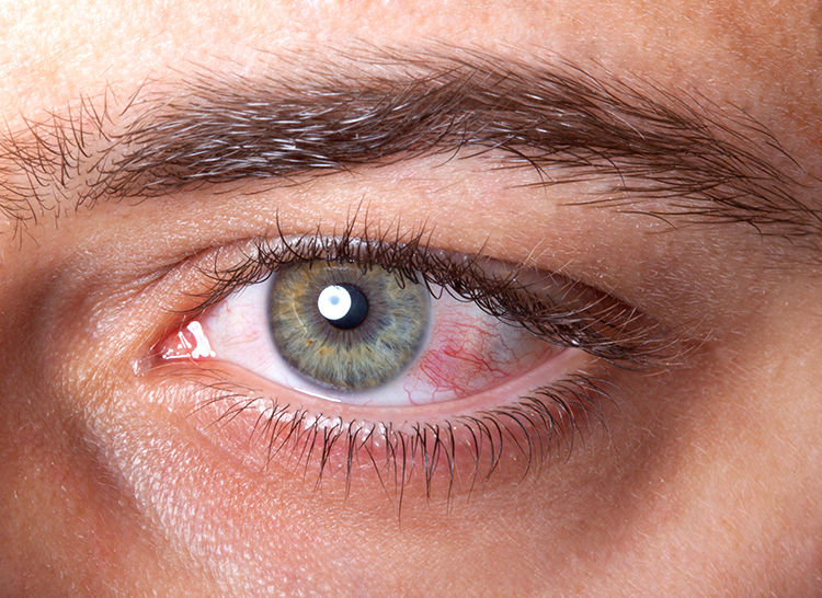 Ojo seco