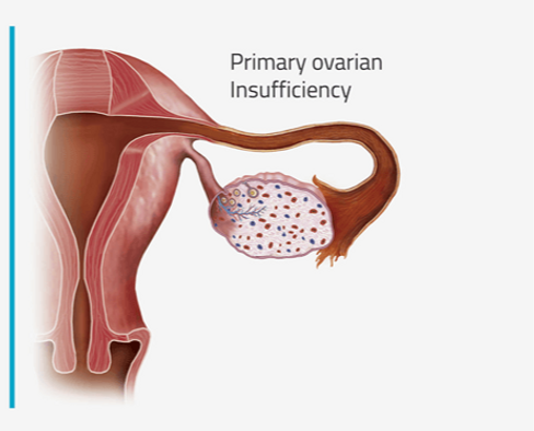 POI-_PRIMARY_OVARIAN_INSUFFICIENTLY_edited.png