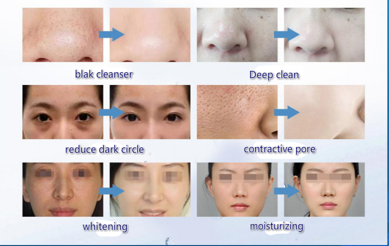 Thumbnail: 2021 Hydrafacials with Skin Analyzer