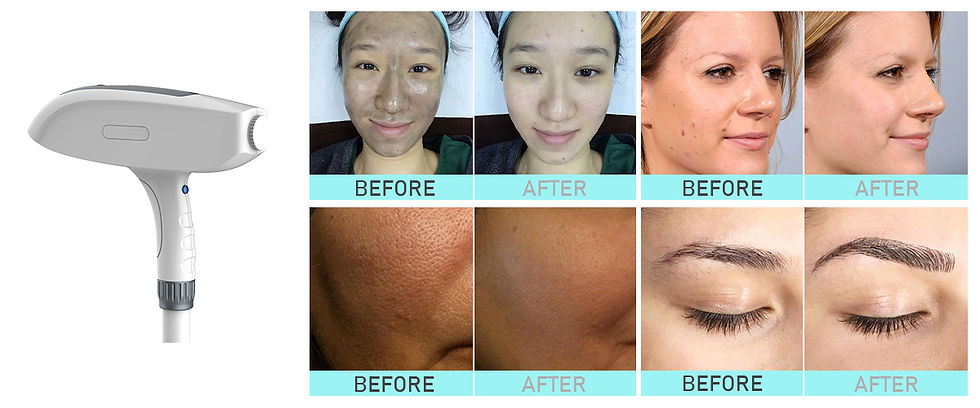 Thumbnail: OPT E-Light IPL laser SHR