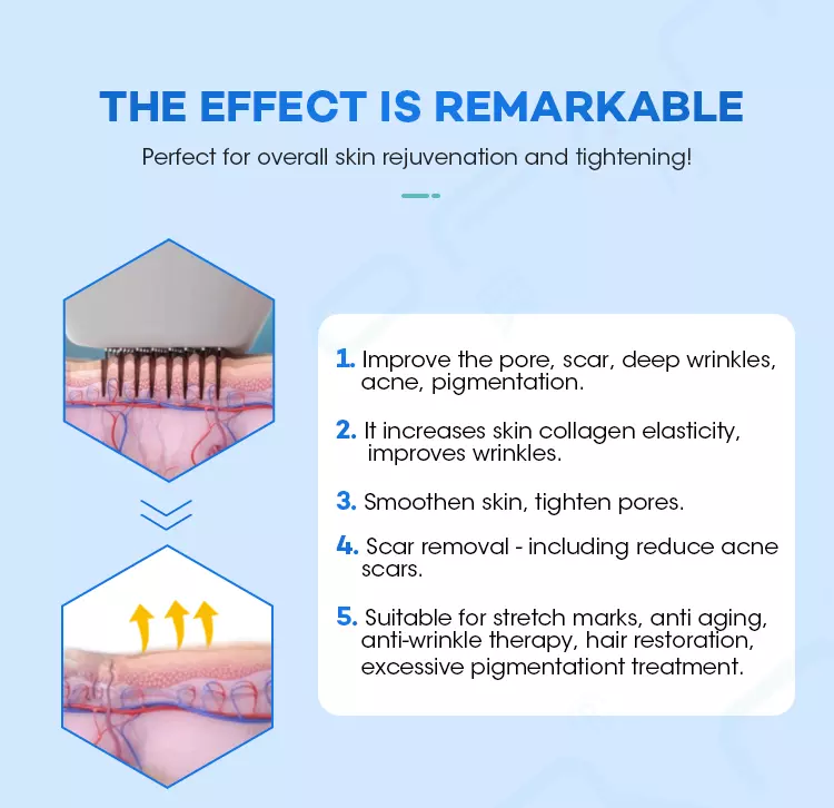 Thumbnail: Fractional RF Microneedle Machine