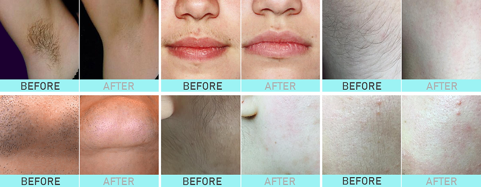 Thumbnail: Diode Laser Hair Removal Machine