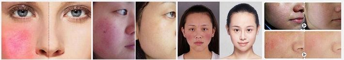 Thumbnail: Diode Laser Beauty Machine- Vein Vascular Remover