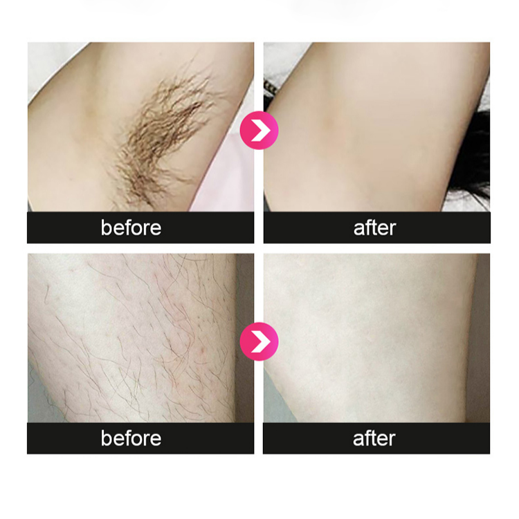 Thumbnail: 808NM Laser Therapy Diode- Hair Removal