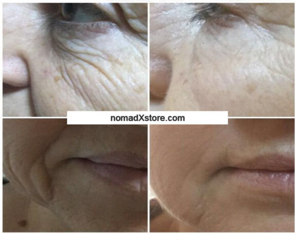 Thumbnail: 7D HIFU Body Slimming Machine