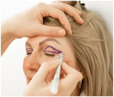 Eyelid Surgery in Delhi