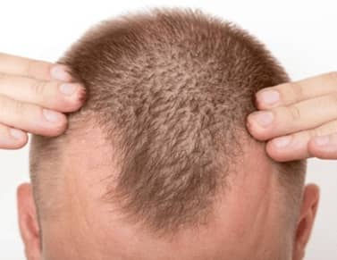Hair Transplant in Delhi