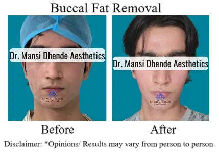 Buccal Fat Removal Before After Results Dr Mansi Dhende Aesthetics