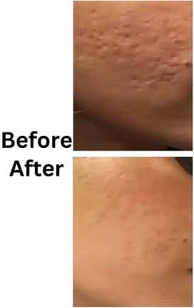 Microneedling Delhi