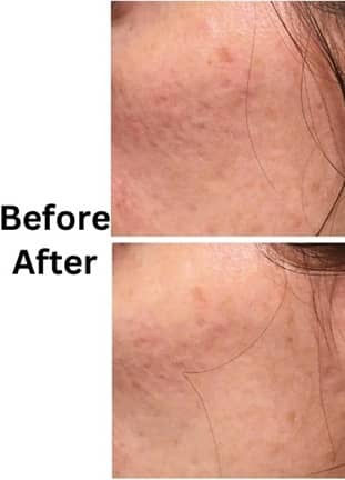Microneedling Delhi NCR