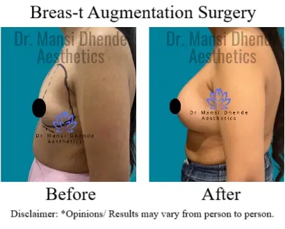 Breast-Augmentation-Surgery-Before-After-Dr-Mansi-Dhende-Aesthetics