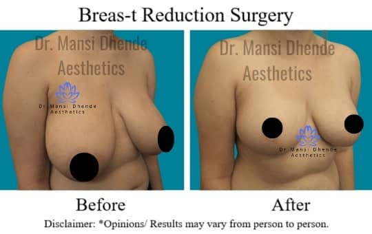 Breast-Reduction-Before-After-Dr-Mansi-Dhende-Aesthetics