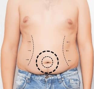 Liposuction Delhi