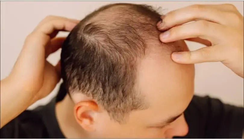 Hair loss on the head of a man