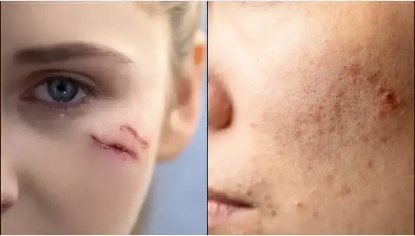 Women's Faces showing Scars due to Acne and Injury