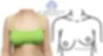 Illustration of a woman with uneven breasts and difference in nipple height