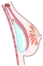 Submuscular Breas-t Implant Delhi