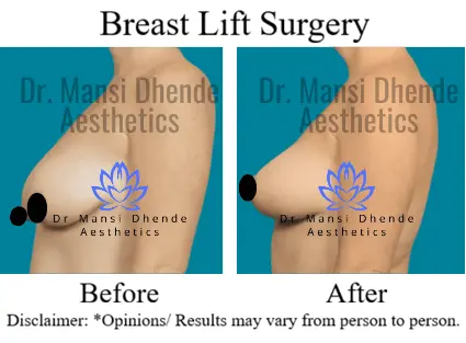 Breast Lift Surgery Before After Photo Dr Mansi Dhende Aesthetics