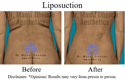 Liposuction Before After Results Dr Mansi Dhende Aesthetics