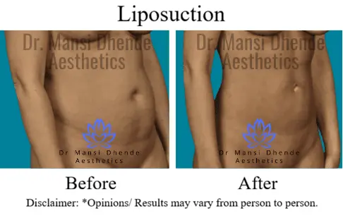 Liposuction Before After Results Dr Mansi Dhende Aesthetics