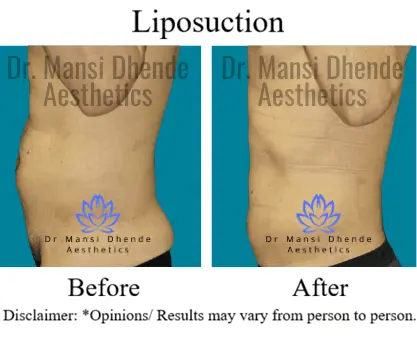 Liposuction Before After Results Dr Mansi Dhende Aesthetics